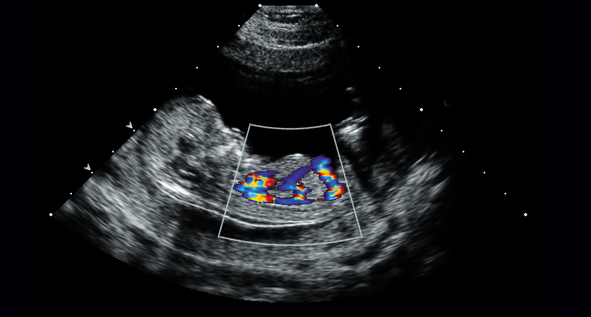 Fetal Echocardiography