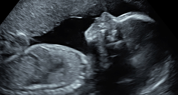 Fetal Growth Scan