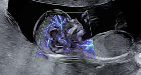 Fetal Neurosonogram