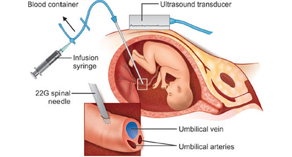 Intraperitoneal Transfusion (IPT)