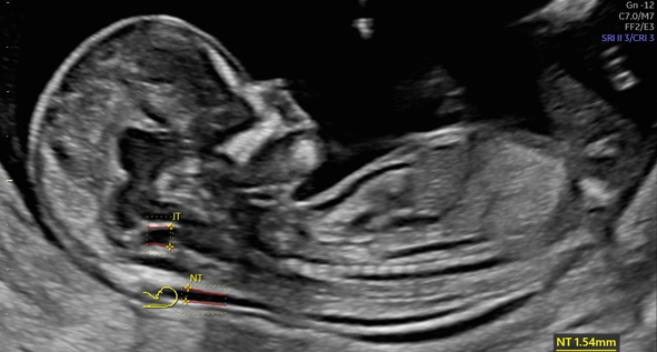 Nuchal Translucency