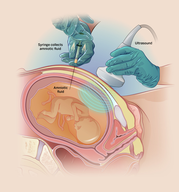 Amniocentesis