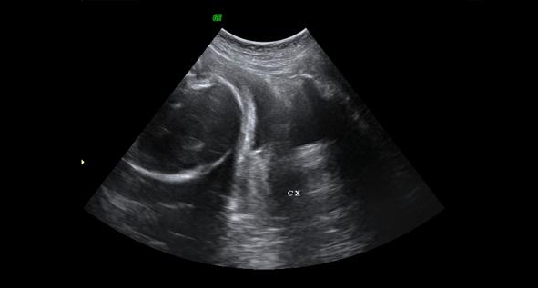 Intraperitoneal Transfusion (IPT)