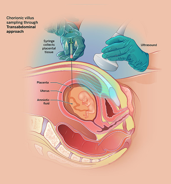 Chorionic-Villus-Sampling.png